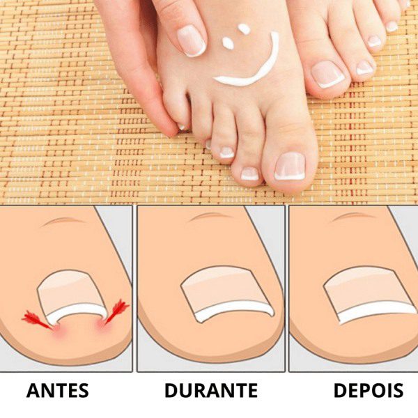 Adesivo Corretor de Unhas Encravadas - PACK 30
