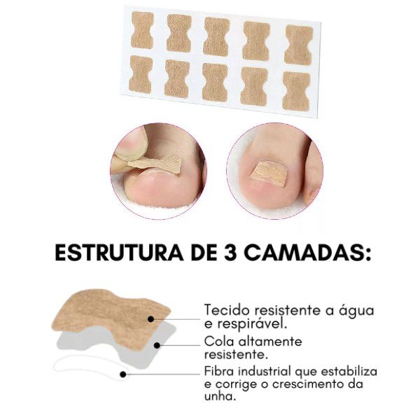 Adesivo Corretor de Unhas Encravadas - PACK 30