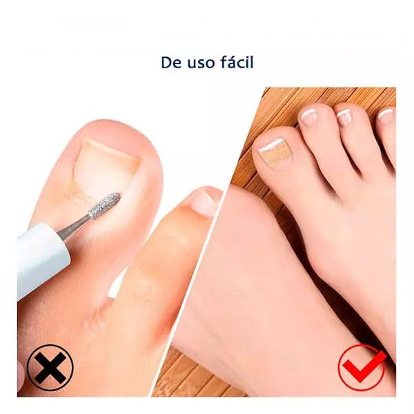 Adesivo Corretor de Unhas Encravadas - PACK 30