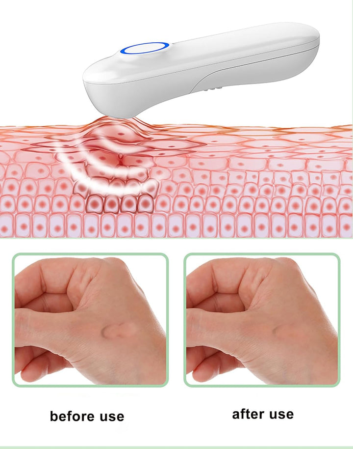 Caneta para Alivio de Picada de Insetos