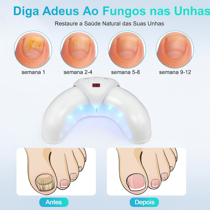 Dispositivo Laser Antifungos para Unhas