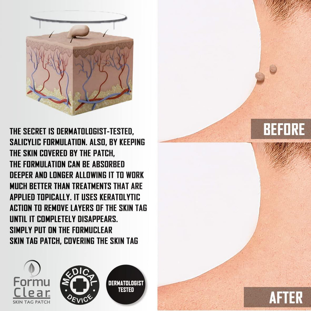 Skin Tag Patch – Elimina Verrugas de Forma Segura, Rápida e Sem Dor