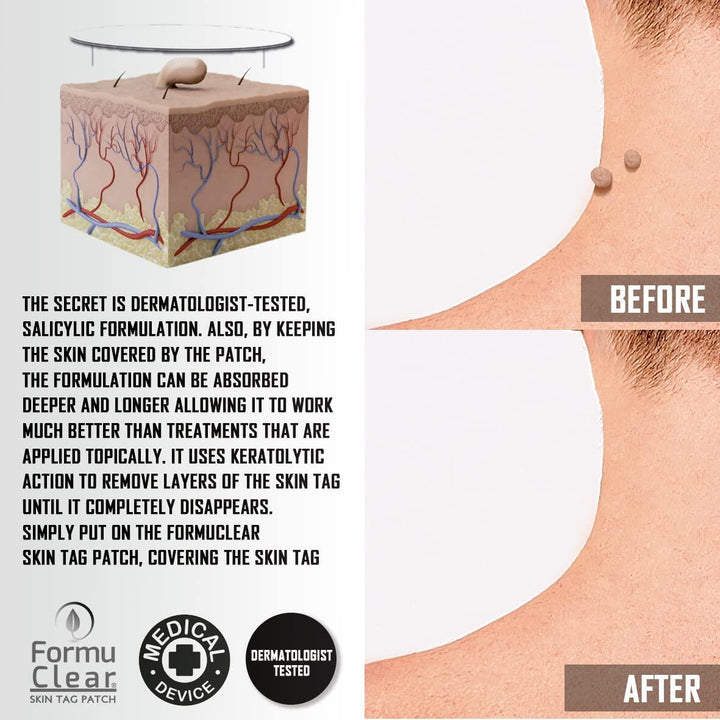 Skin Tag Patch – Elimina Verrugas de Forma Segura, Rápida e Sem Dor