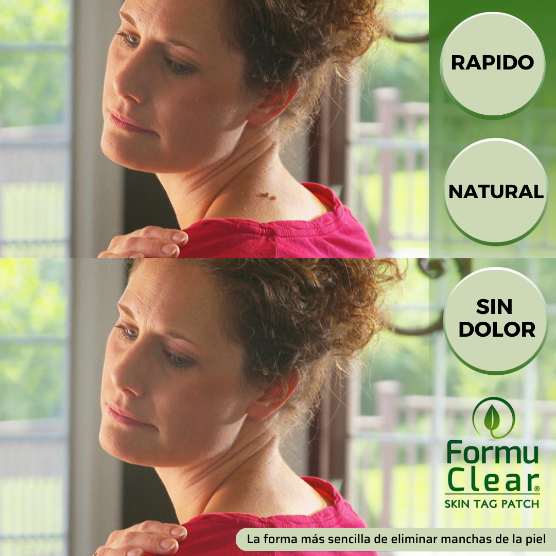 Skin Tag Patch – Elimina Verrugas de Forma Segura, Rápida e Sem Dor