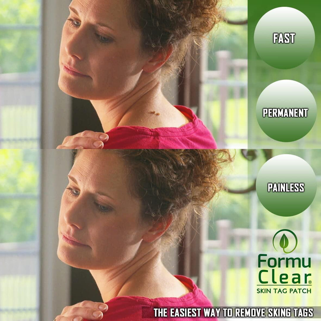 Skin Tag Patch – Elimina Verrugas de Forma Segura, Rápida e Sem Dor