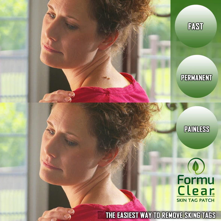 Skin Tag Patch – Elimina Verrugas de Forma Segura, Rápida e Sem Dor