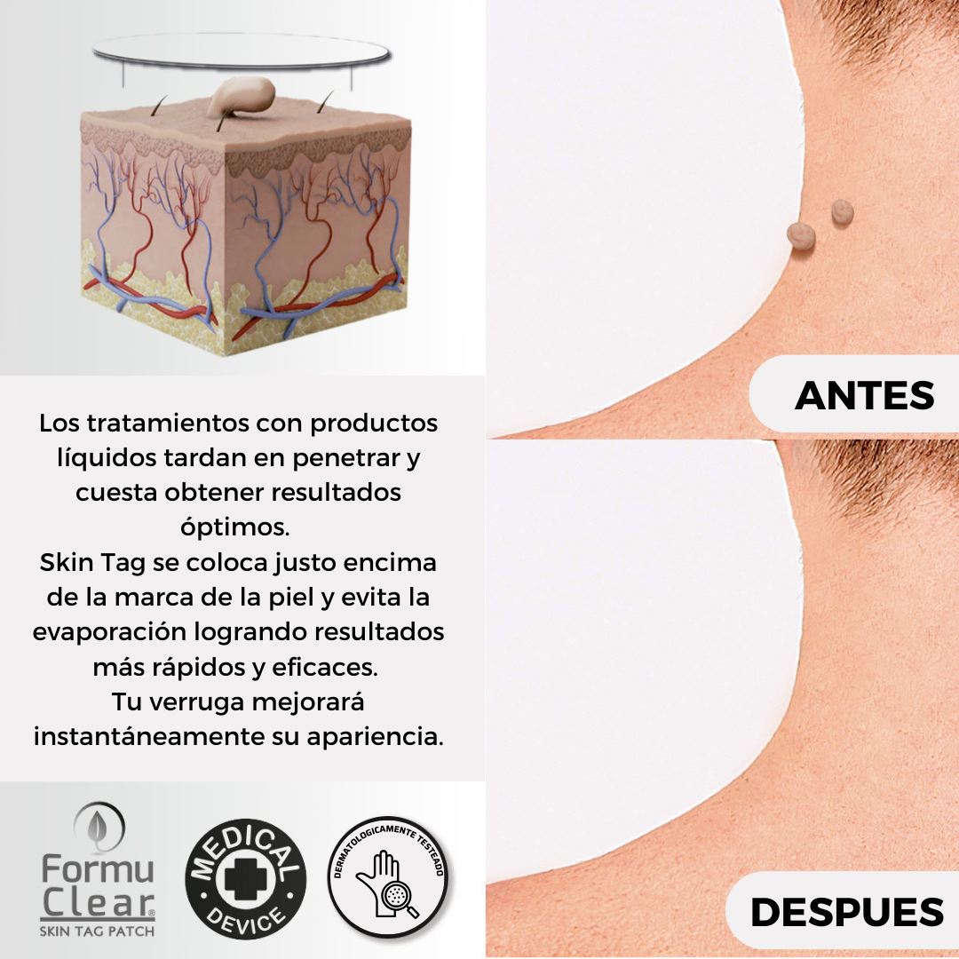 Skin Tag Patch – Elimina Verrugas de Forma Segura, Rápida e Sem Dor