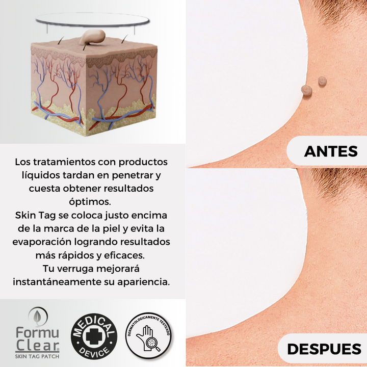 Skin Tag Patch – Elimina Verrugas de Forma Segura, Rápida e Sem Dor