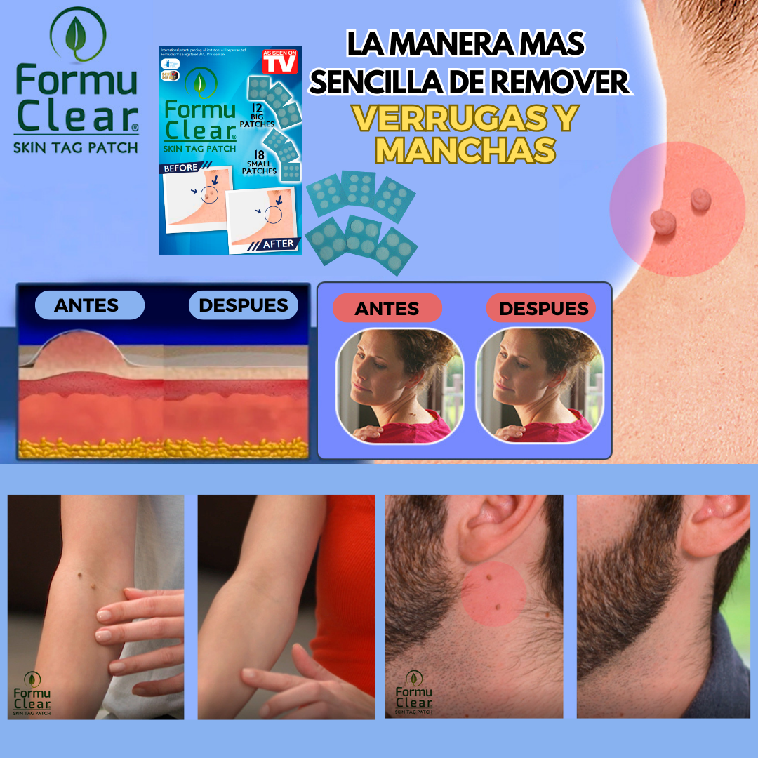 Skin Tag Patch – Elimina Verrugas de Forma Segura, Rápida e Sem Dor