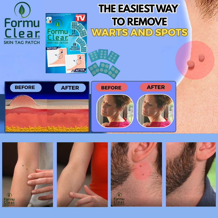 Skin Tag Patch – Elimina Verrugas de Forma Segura, Rápida e Sem Dor